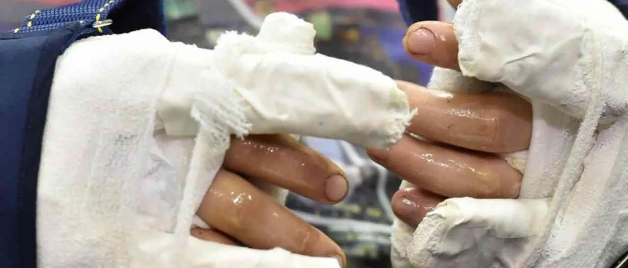 Aveva perso entrambe le mani in un incidente sul lavoro, reimpiantate da un’equipe di Verona