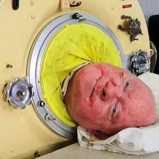 È morto “Polio Paul”, l’uomo che ha vissuto più di 70 anni all’interno di un polmone d’acciaio