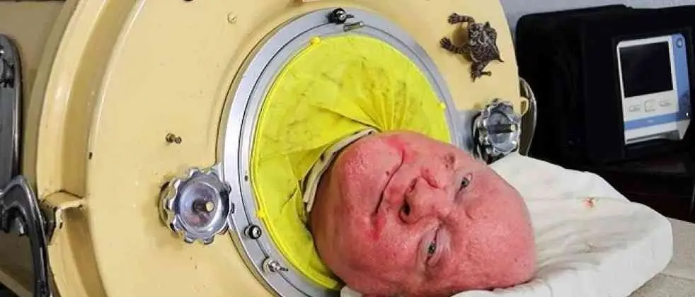 È morto “Polio Paul”, l’uomo che ha vissuto più di 70 anni all’interno di un polmone d’acciaio