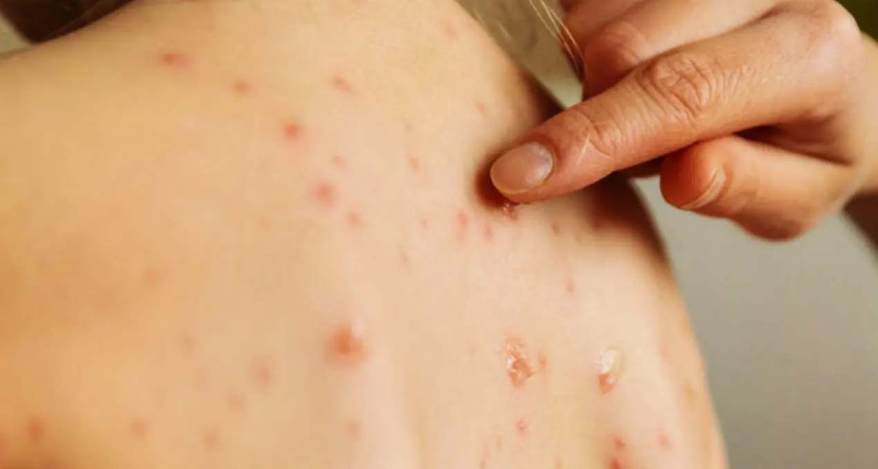 Morbillo, impennata di casi in Calabria: «Oltre 15 volte in più rispetto al 2025. Copertura vaccinale insufficiente in tutta Italia»\n