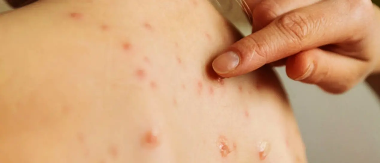 Morbillo e pertosse, l’allarme degli esperti: «In Europa casi aumentati di 60 volte dal 2022 al 2023»