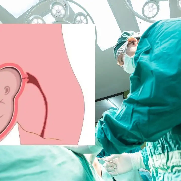 A Torino gravidanza con l’utero in un’ernia fuori dall’addome, solo 16 casi al mondo in 50 anni