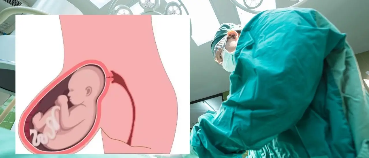 A Torino gravidanza con l’utero in un’ernia fuori dall’addome, solo 16 casi al mondo in 50 anni