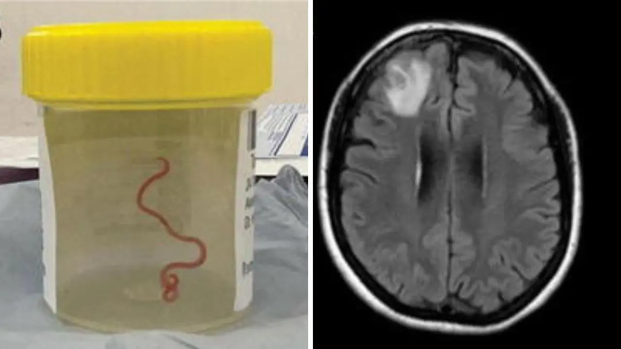 Ricoverata con febbre, dolori e depressione, ma aveva un verme vivo nel cervello. L’incredibile scoperta in Australia