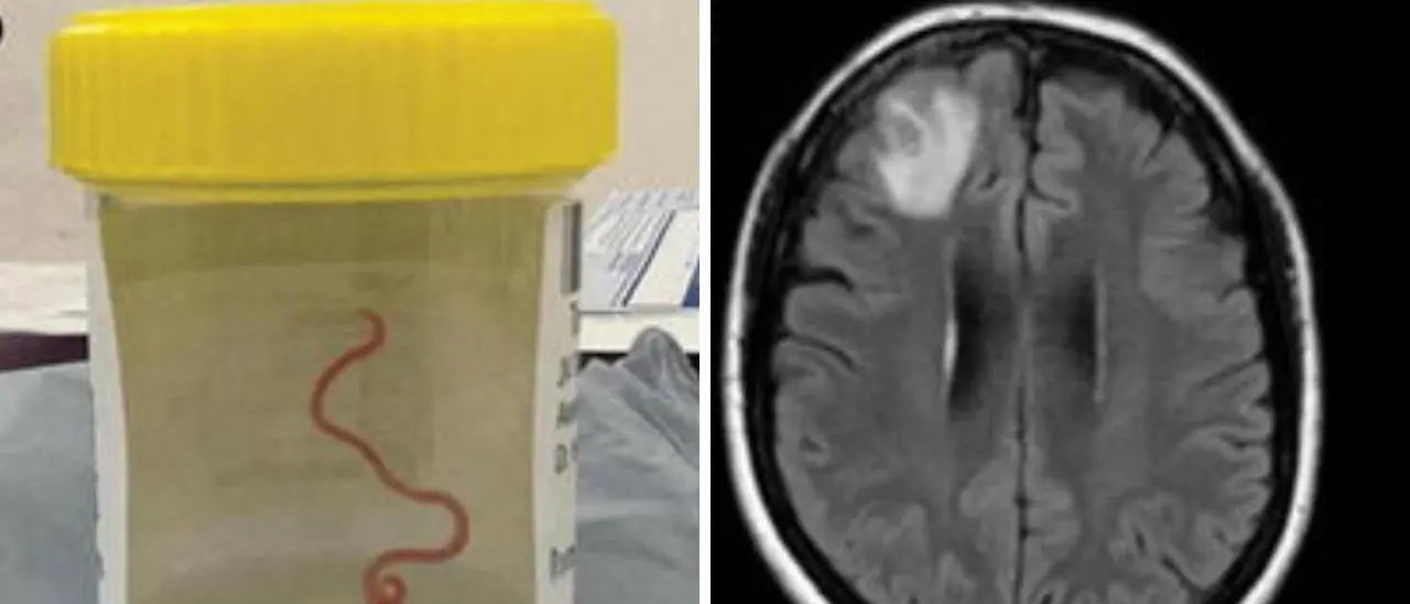 Ricoverata con febbre, dolori e depressione, ma aveva un verme vivo nel cervello. L’incredibile scoperta in Australia