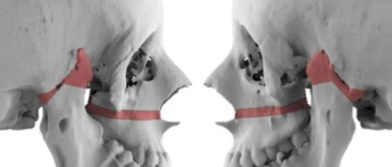 Era nata con la bocca chiusa, a 16 anni può sorridere: eccezionale intervento all’ospedale di Catania