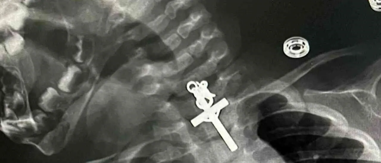 Respirava male e piangeva, le trovano un crocifisso nella gola: complicato intervento su una bimba di 10 mesi