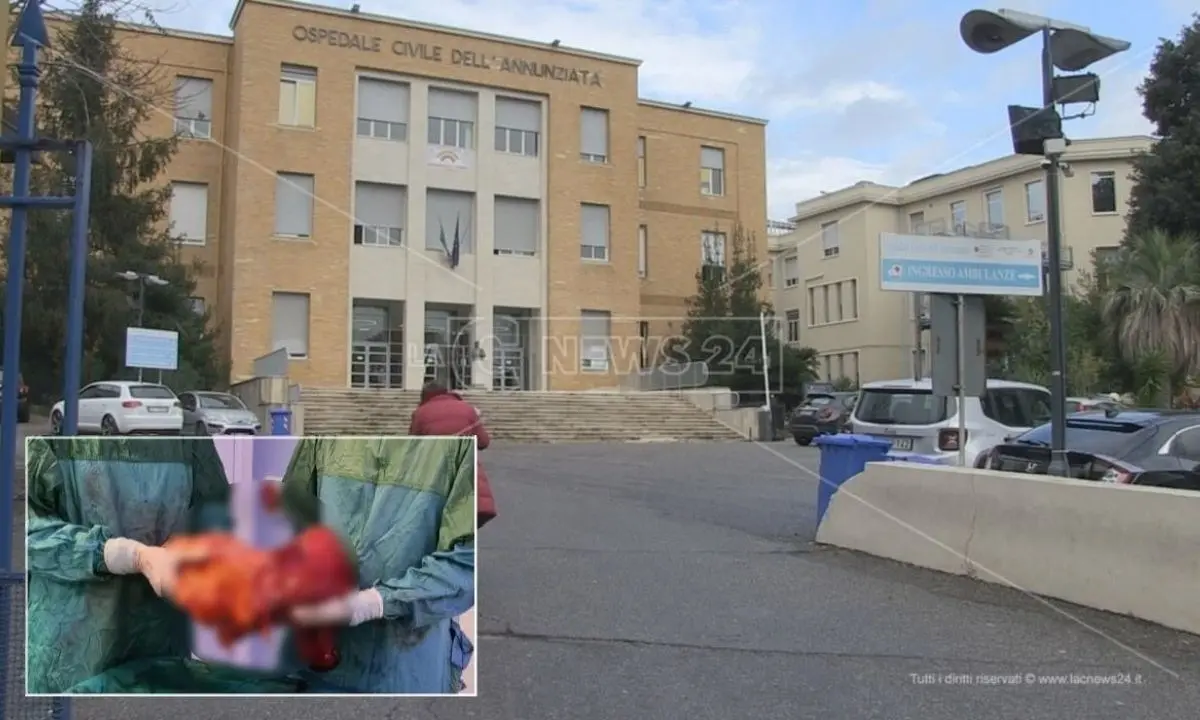 Intervento record in Calabria, asportato a Cosenza un tumore di 7,5 chili a una donna