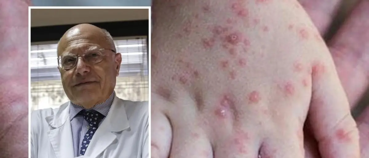 Vaiolo delle scimmie, Galli: «Elevare a emergenza internazionale? È un atto dovuto»