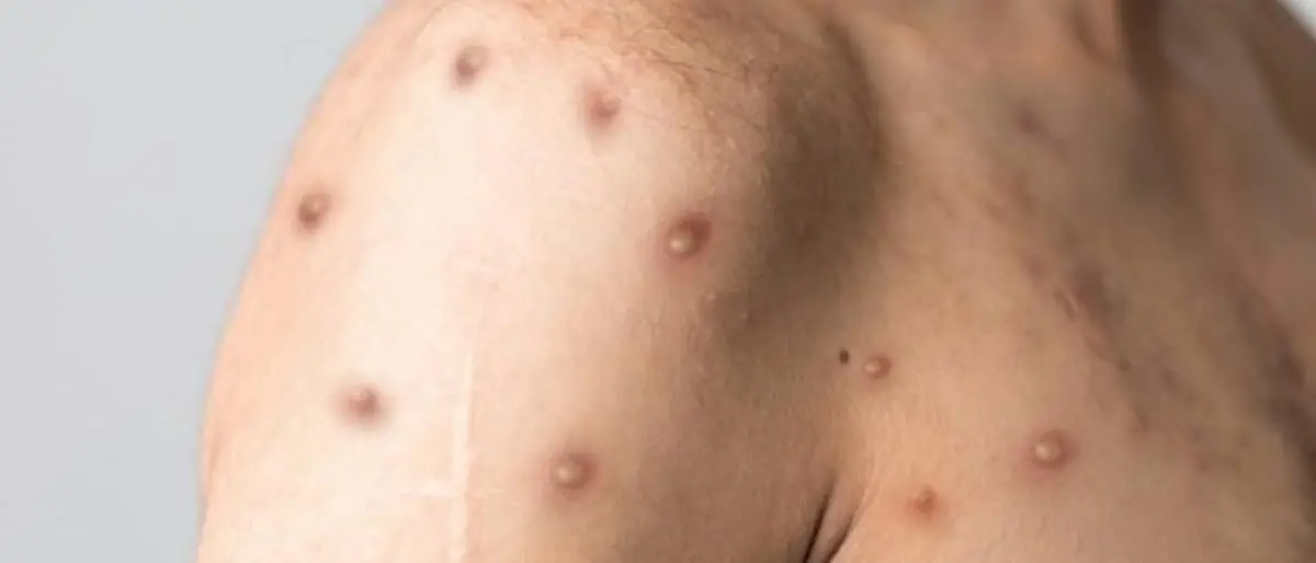 Vaiolo delle scimmie, l’allarme dell’Oms: «Europa epicentro dell’epidemia»