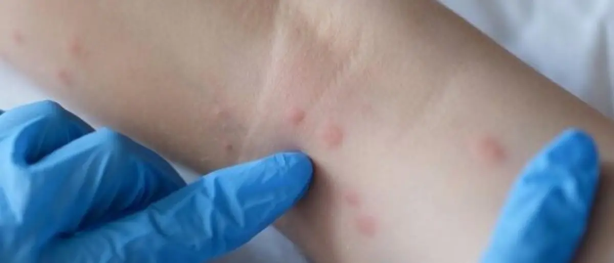 Vaiolo delle scimmie, l’Oms: «È emergenza sanitaria globale»