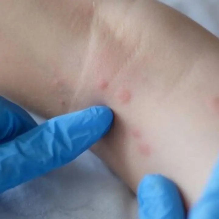 Vaiolo delle scimmie, parte in Italia la vaccinazione: distribuite le prime dosi a 4 regioni