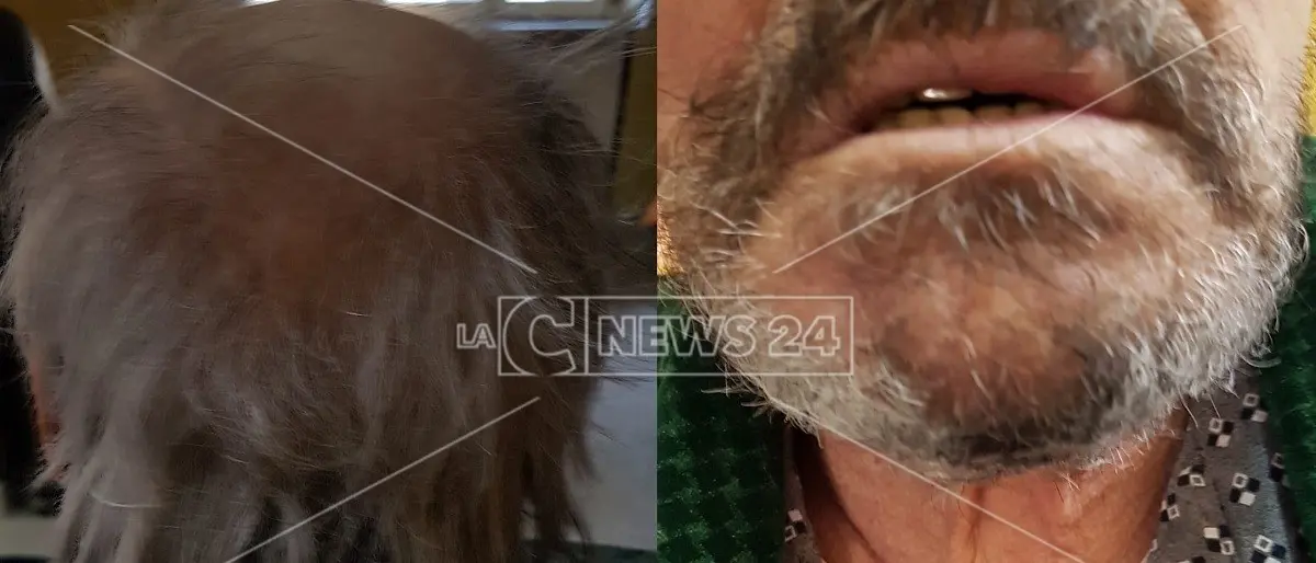 Esce dall'ospedale che sembra un barbone, la denuncia del figlio: «È questa la nostra sanità?»