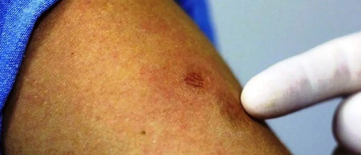 “U còcciu annestràtu”, il vaccino che ha accomunato le passate generazioni