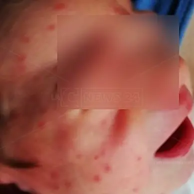 Mamme e neonati assaliti da nugoli di zanzare. L'ospedale di Lamezia come una giungla