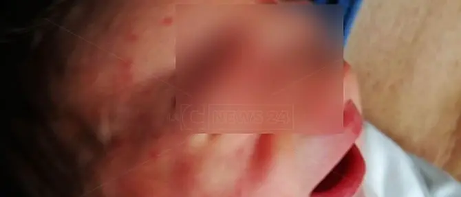 Mamme e neonati assaliti da nugoli di zanzare. L'ospedale di Lamezia come una giungla