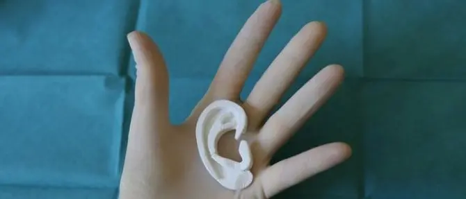 Ricostruito orecchio a 13enne grazie alla stampa 3D: era nato senza