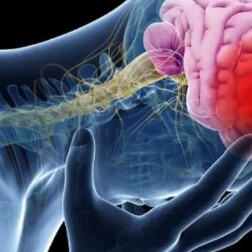 Ricerca, a Vibo Valentia focus sull’ictus cerebrale