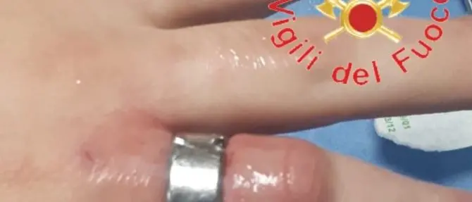 Anello troppo stretto al dito, a Catanzaro intervengono i vigili del fuoco