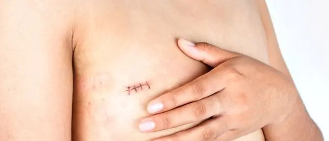 Cancro, per i pazienti oncologici a Lamezia tatuaggi paramedicali gratis