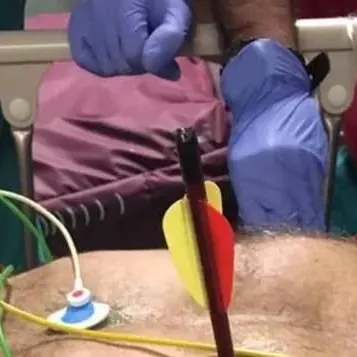 Trapassato da una freccia di 30cm al cuore, salvato