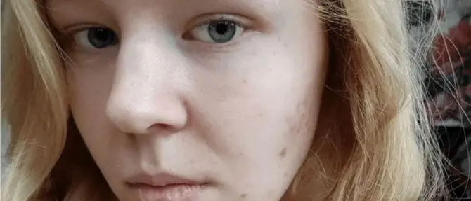 Nessuna eutanasia, Noa si è lasciata morire. I genitori: «Rispettate il nostro dolore»