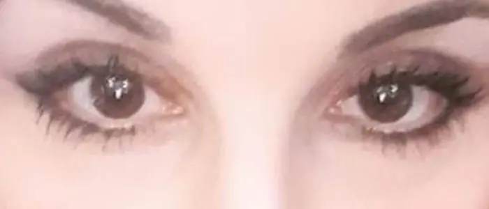 «Finalmente potrà rivedere i figli»: intervento con le staminali per la donna ustionata dall’ex