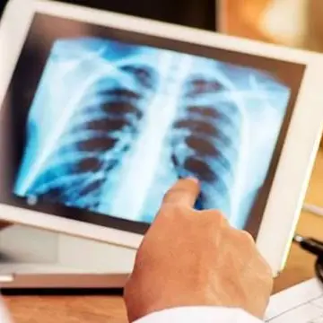 Tubercolosi, Lamezia ospita un evento scientifico in occasione del Tb day