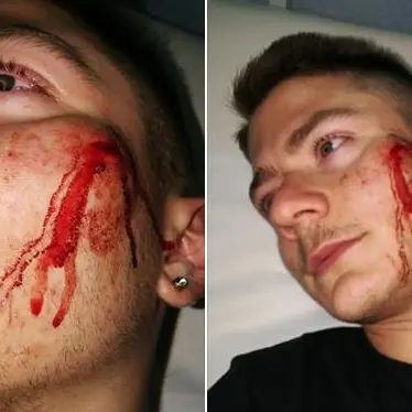 Giovane aggredito dai bulli, la madre condivide le immagini su Facebook