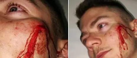 Giovane aggredito dai bulli, la madre condivide le immagini su Facebook