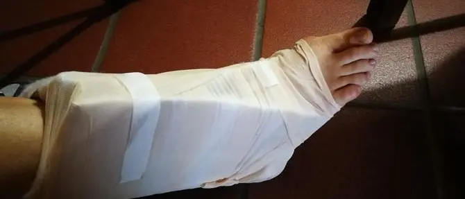 Si frattura il piede e la “ingessano” col cartone da imballaggi - VIDEO