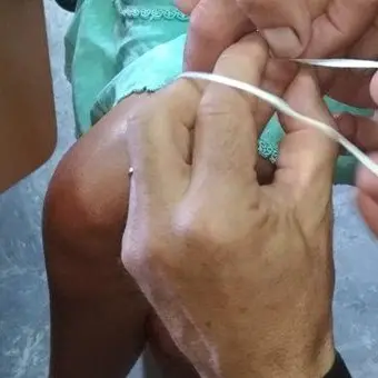 Le si gonfia il dito per via di un anello stretto, intervengono i vigili del fuoco