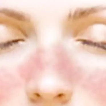 Catanzaro: la storia di Luana affetta da Lupus