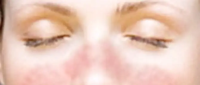 Catanzaro: la storia di Luana affetta da Lupus