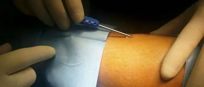 Lamezia, un sensore sottocutaneo per il monitoraggio della glicemia nei giovani