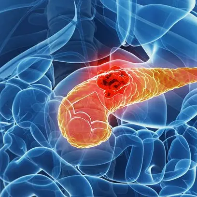 Dall’Università della Calabria una speranza per curare il carcinoma del dotto pancreatico