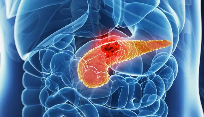 Dall’Università della Calabria una speranza per curare il carcinoma del dotto pancreatico