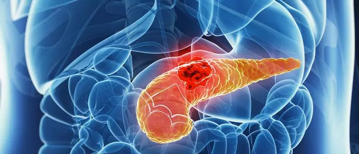 Dall’Università della Calabria una speranza per curare il carcinoma del dotto pancreatico