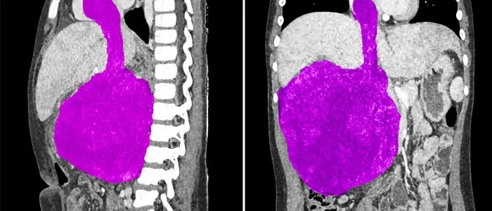 A Roma rimosso un tumore del rene che si estendeva fino al cuore in una bimba di 8 anni