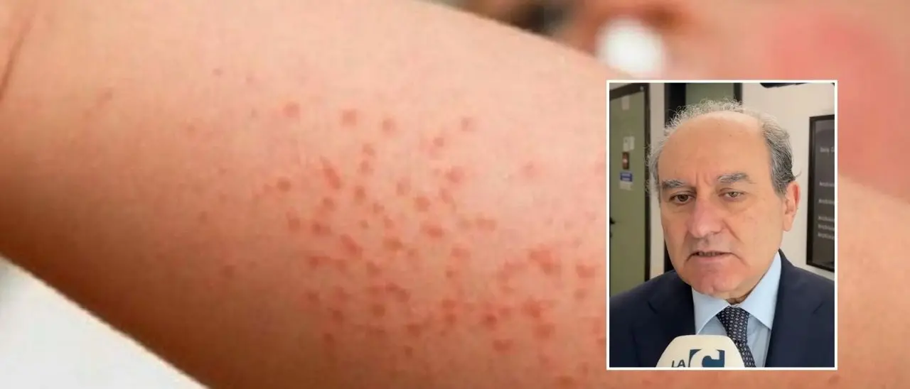 Corigliano Rossano, il panico per la scabbia è una bolla di sapone. Rizzo (Asp): «Non c’è alcun pericolo»