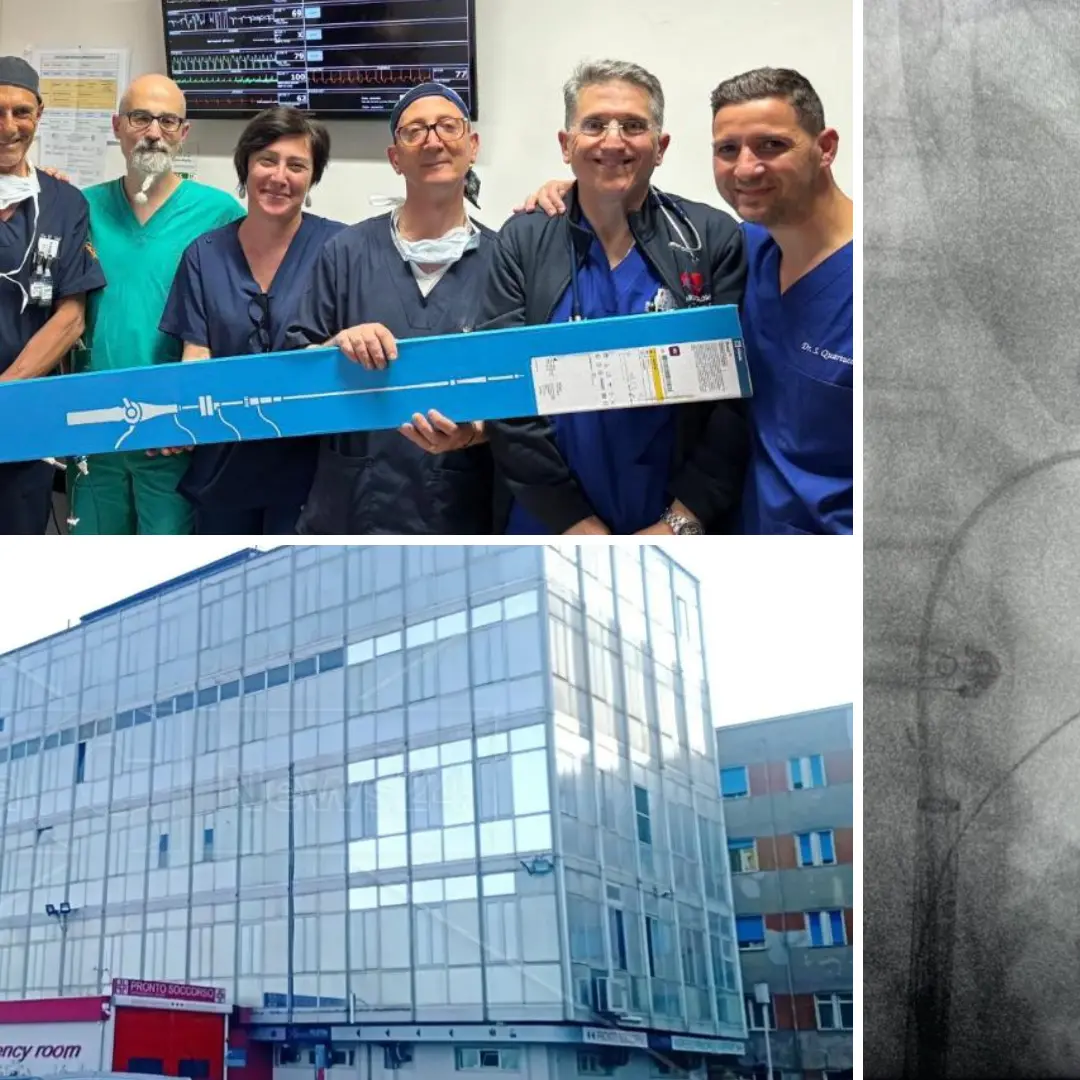 Ospedale Polistena, impiantati i primi pacemaker senza fili: sono 10 volte più piccoli e la procedura è mini invasiva