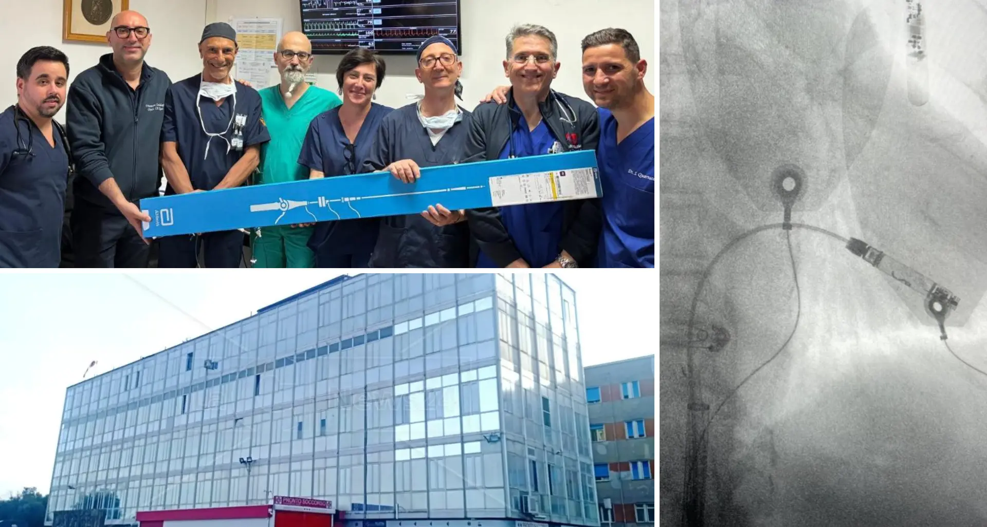 Ospedale Polistena, impiantati i primi pacemaker senza fili: sono 10 volte più piccoli e la procedura è mini invasiva