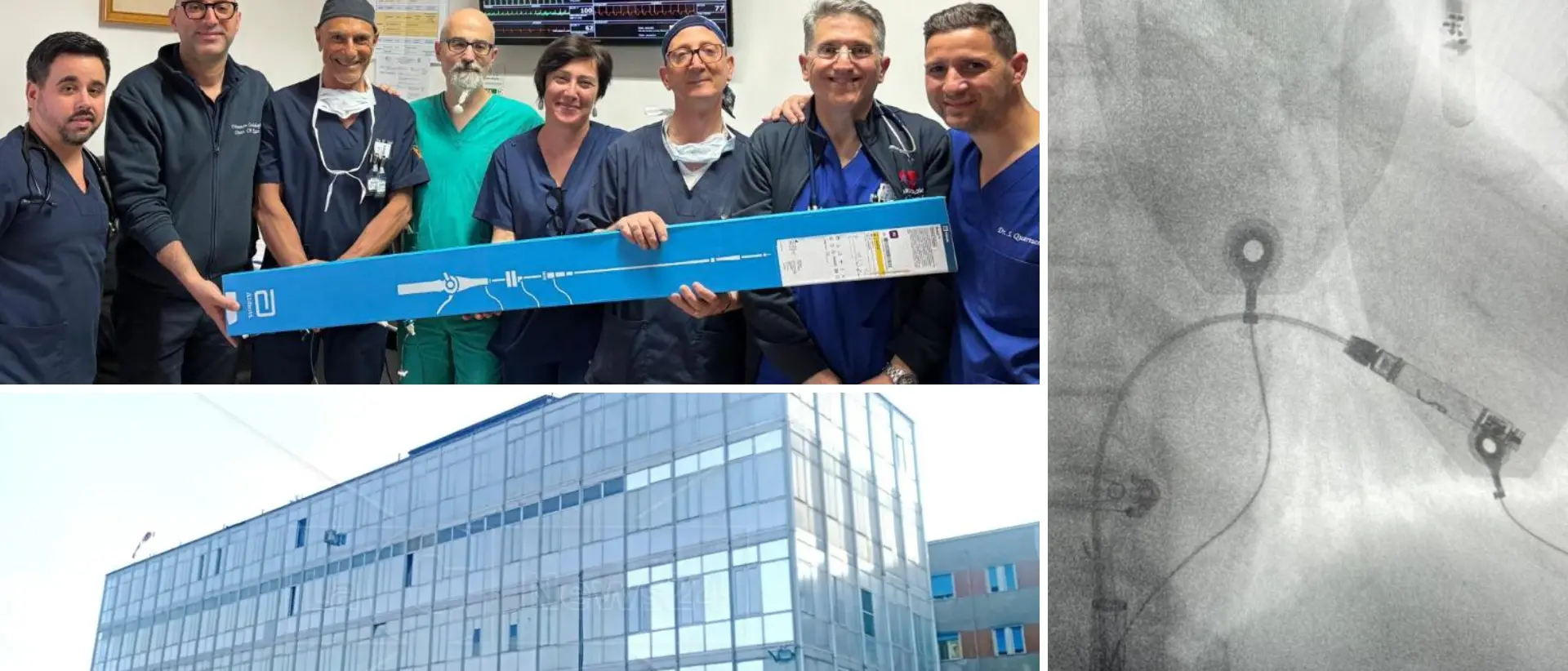 Ospedale Polistena, impiantati i primi pacemaker senza fili: sono 10 volte più piccoli e la procedura è mini invasiva