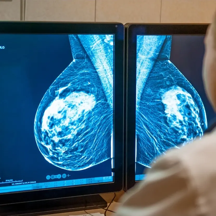 Screening oncologici, Calabria ultima per adesione. Gimbe: «Regioni devono fare di più, diagnosi precoce fondamentale»