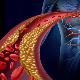 Dislipidemia, ecco come prevenire infarti e ictus: i consiglio dell'esperto