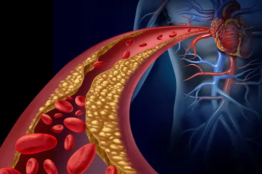 Dislipidemia, ecco come prevenire infarti e ictus: i consiglio dell'esperto