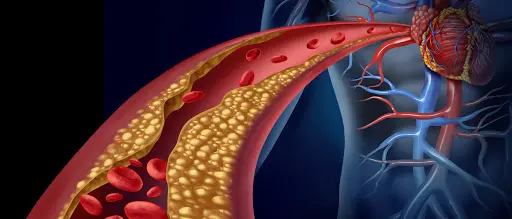 Dislipidemia, ecco come prevenire infarti e ictus: i consiglio dell'esperto