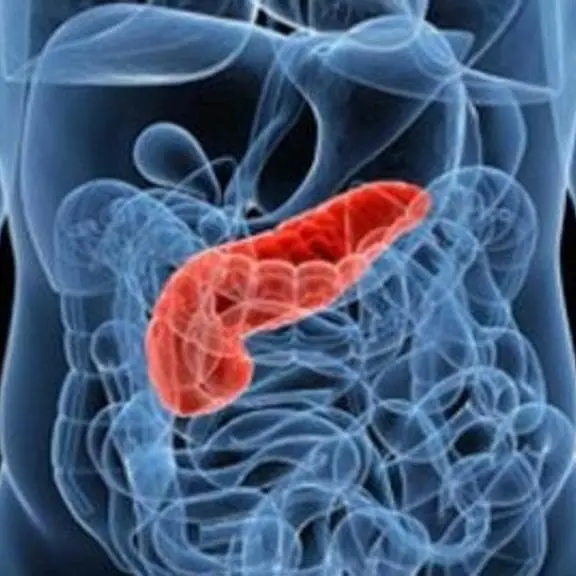 Tumore al pancreas, individuata proteina che ne favorisce la crescita