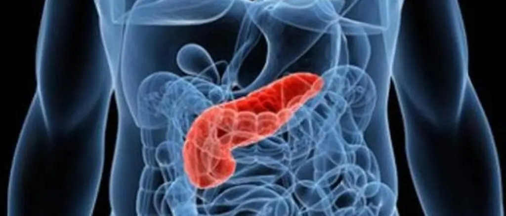 Tumore al pancreas, individuata proteina che ne favorisce la crescita