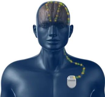 Parkinson, elettrocateteri direzionali per una terapia personalizzata